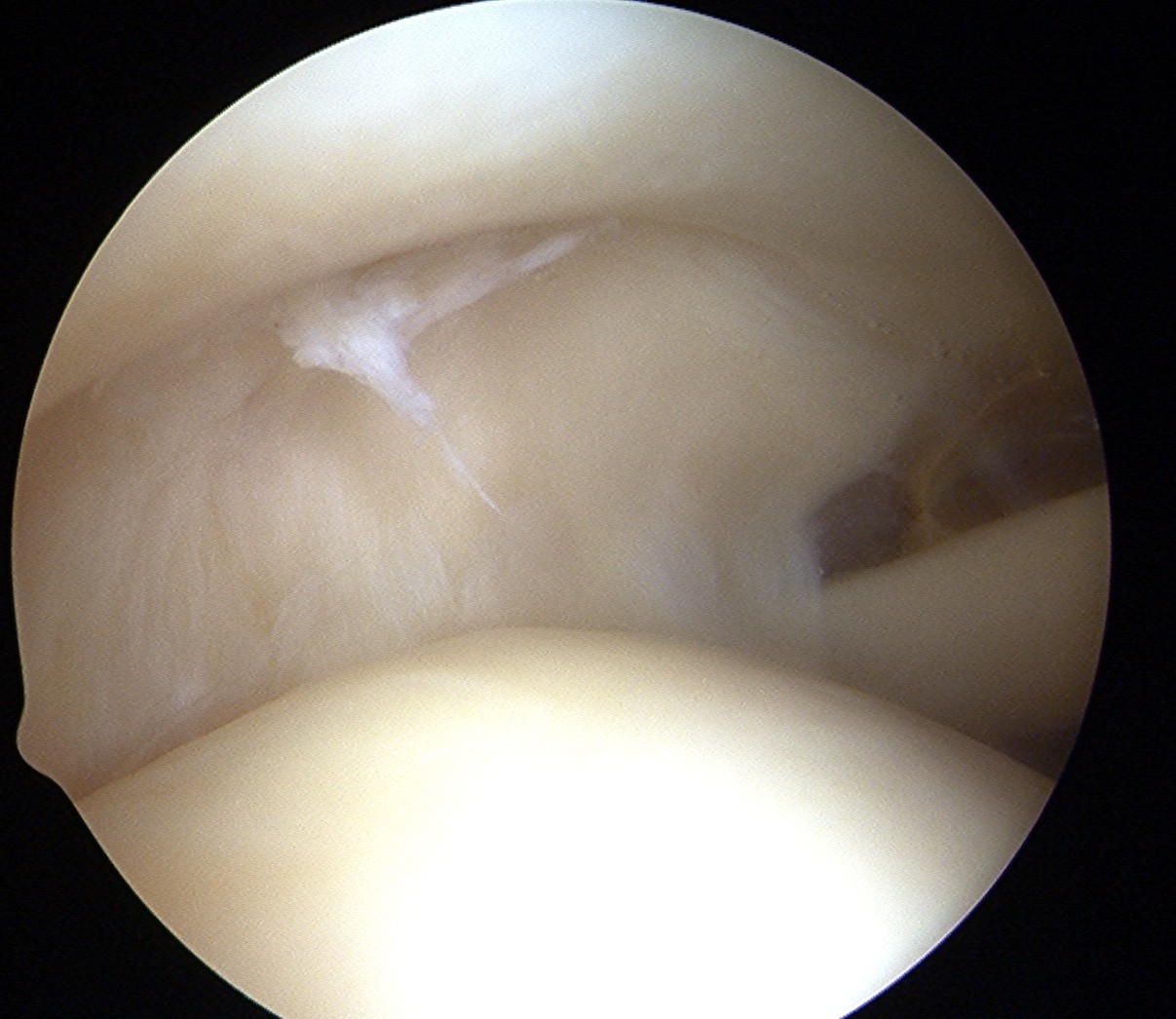 Supraspinatous Tendon Normal Crescent Variant